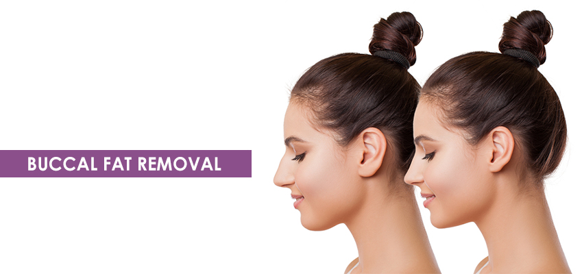 Buccal Fat Removal Surgery